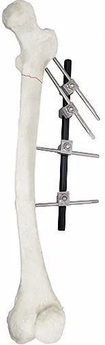 Adjustable External Fixator in White & Black, for Bone Fixation, Titanium Alloy - Image 2