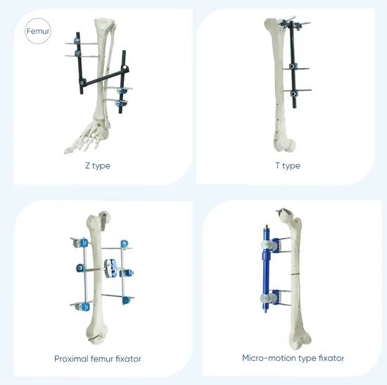 Xc Medico Orthopedic Medical Device Bone Fixation Tibia and Femur External Fixator - Image 6