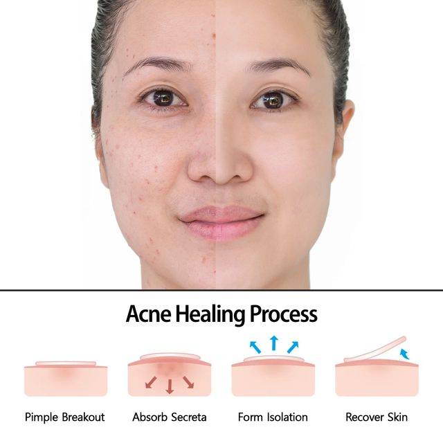 CanVita Pimple Patches - 72 Dots of Effective Solution for acne and pimples , tea tree oil and salicylic acid - Image 5
