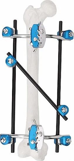 Adjustable External Fixator in White & Black, for Bone Fixation, Titanium Alloy - Image 6