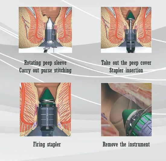 Hospital Minor Minimally Invasive Surgery Pph Medical Disposable Anorectal Staplers - Image 3