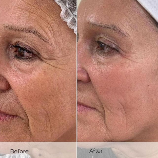 Premium Quality Profhilo Available for Immediate Shipping Fast Delivery Buy Now for Smooth Youthful Skin - Image 3