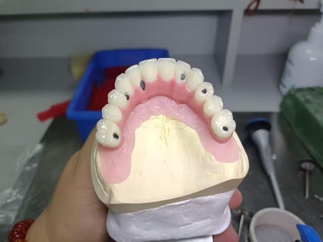 All on Dental Implants with Zirconia Abutment Dental Implant Titanium Bridges and Screwed Crowns for Oral Recovery - Image 4
