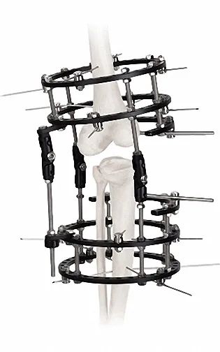 Adjustable External Fixator in White & Black, for Bone Fixation, Titanium Alloy - Image 4
