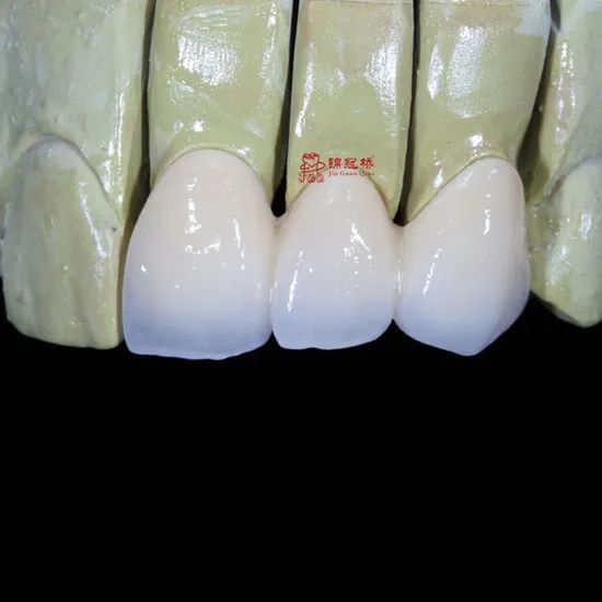 Customized Remote All Ceramic Teeth Supports Browsing Files in Various Formats Stl Ply Dcm Impression Model - Image 1