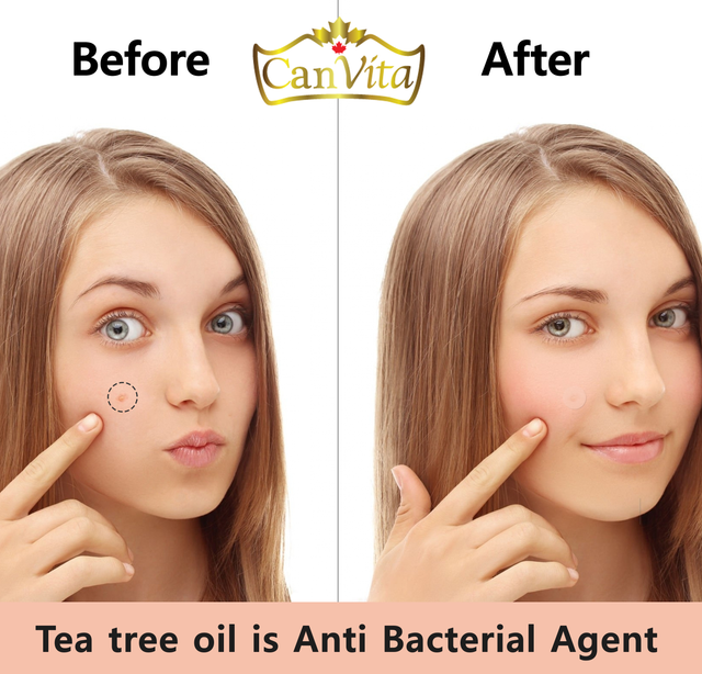 CanVita Pimple Patches - 72 Dots of Effective Solution for acne and pimples , tea tree oil and salicylic acid - Image 3