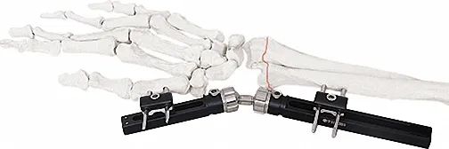 External Fixator for Bone Fixation, White & Black, Titanium Alloy Design - Image 1
