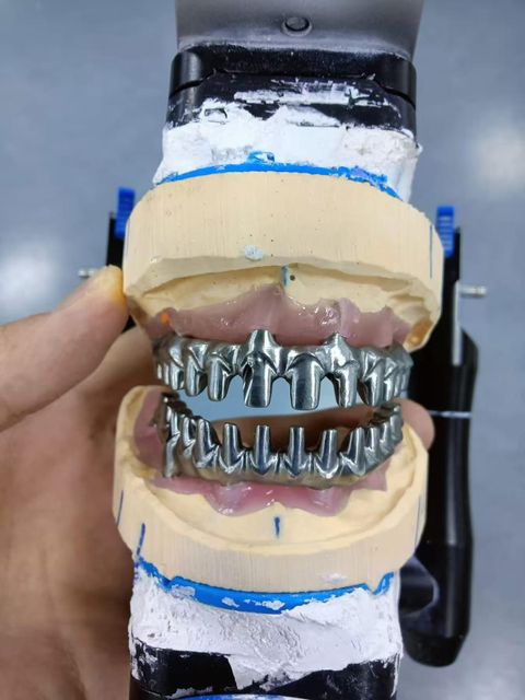 All on Dental Implants with Zirconia Abutment Dental Implant Titanium Bridges and Screwed Crowns for Oral Recovery - Image 3