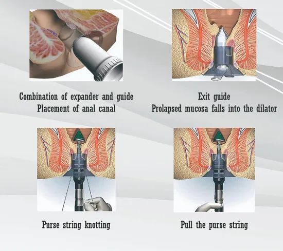 Hospital Minor Minimally Invasive Surgery Pph Medical Disposable Anorectal Staplers - Image 4