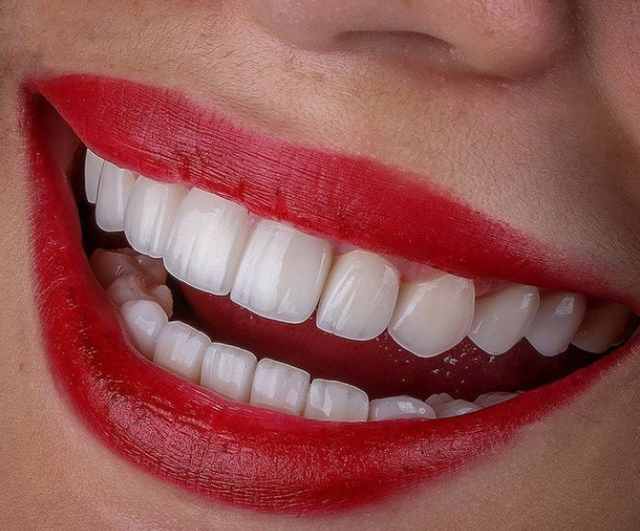 China Implant Dental Factory Custom Metal Ceramic Zirconia Crown and Bridges Good Price - Image 4