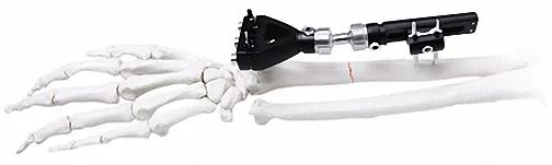 Adjustable External Fixator in White & Black, for Bone Fixation, Titanium Alloy - Image 5