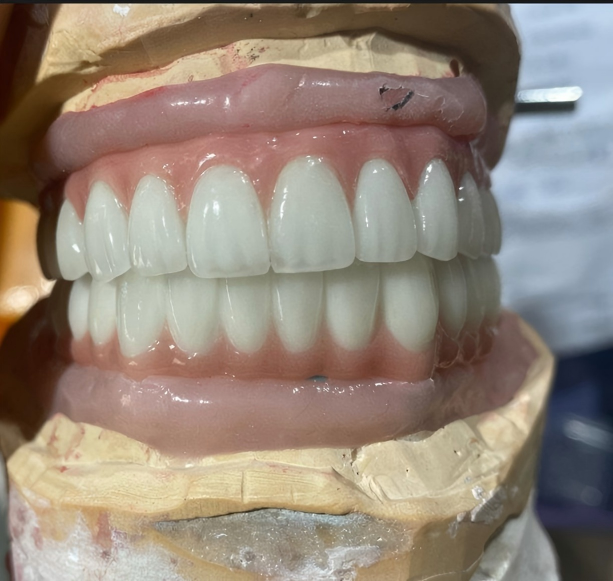 Implant Supported Removable Complete Denture En shenzhen Dental Lab - Image 4