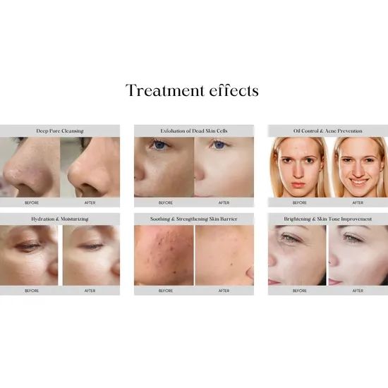 Multifunctional Beauty Machine Hydra Skin Rejuvenation Facial Hydro Microdermabrasion Machine - Image 2