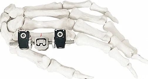 External Fixator for Bone Fixation, White & Black, Titanium Alloy Design - Image 3