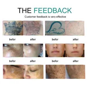 Advanced Pico Laser Hair Removal & Tattoo Removal System - Image 6