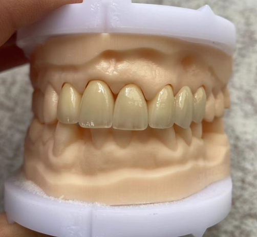 shenzhen Full Mouth Zirconia Crowns Manufacturers, Suppliers, Factory, Laboratory - Myy Dental Technology - Image 4