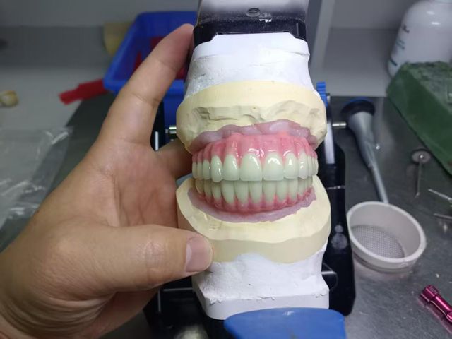 Total Implant PFM Bridge China Dental Lab Zirconia Dental Lab China Outsourcing - Image 3